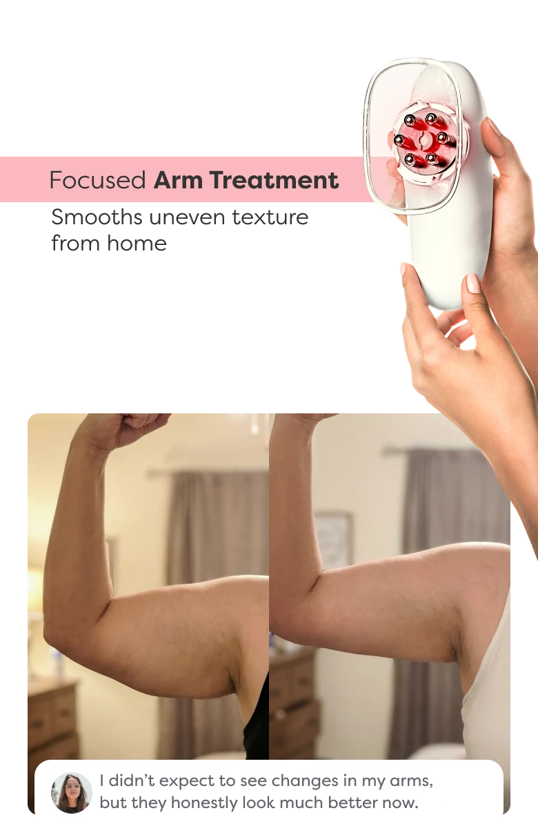 Before and after comparison showing visible improvement in arm contour and firmness after using Redu Sculpt.
