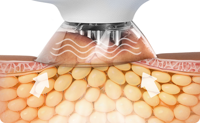 Vacuum therapy applied to the body to help improve skin texture and overall appearance.