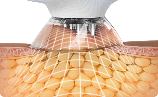 Micro-contour heads targeting stubborn areas to support localized body sculpting.